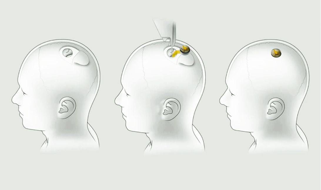 Neuralink's brain-machine interface technology sinks electrodes into the brain then uses a chip to communicate with computers outside your skull.